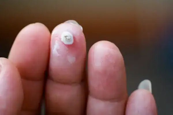 Image of white wart before cryopen treatment Bognor Regis