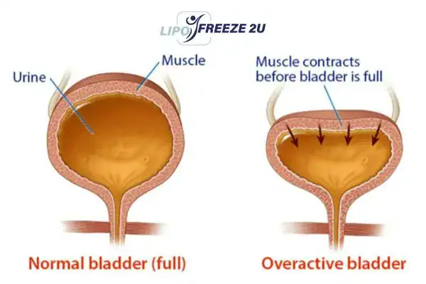 diagram of overactive bladder treatment Bognor Regis