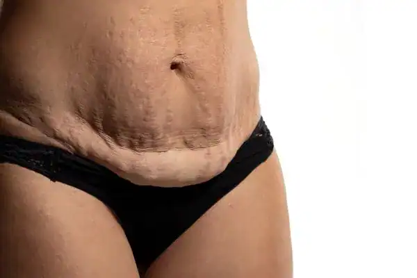loose skin after weight loss injections Bognor Regis