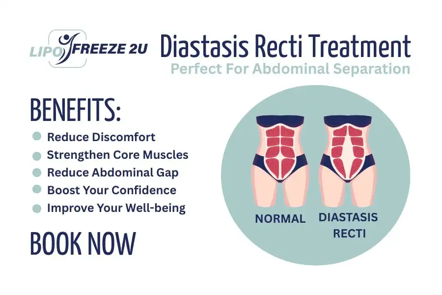 Benefits of body toning treatment Bognor Regis for Diastasis recti
