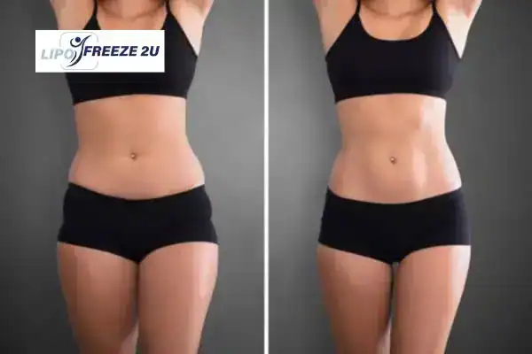 How Can LIPO FREEZE 2U Support Your Post-Pregnancy Body Recovery Bognor Regis?