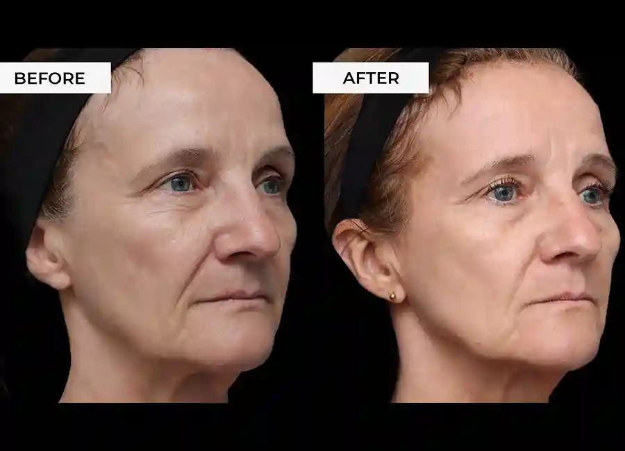 How Many RF Microneedling Sessions Will You Need to See a Difference Bognor Regis?