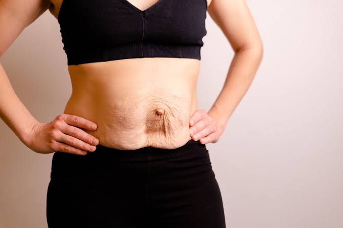 Is Surgery Really the Only Way to Repair Diastasis Recti Bognor Regis?