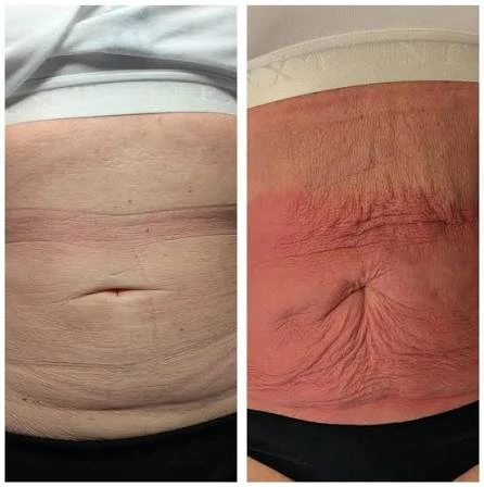 How Does RF Microneedling Improve Crepey, Thin and Uneven Skin Texture Bognor Regis?