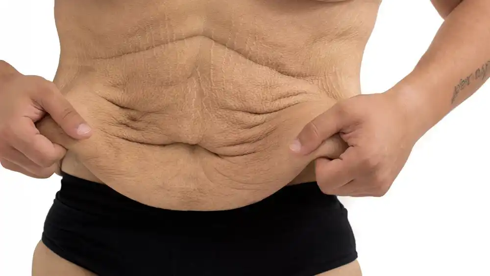 RF Microneedling for Loose Skin: How Can It Help Tighten and Reshape the Skin Bognor Regis?